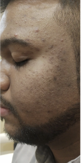 Before Skin Treatment