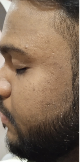 After Skin Treatment