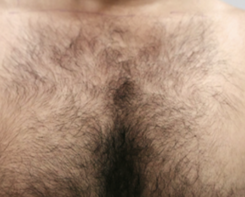 Before Laser Hair Removal