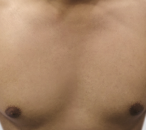 After Laser Hair Removal