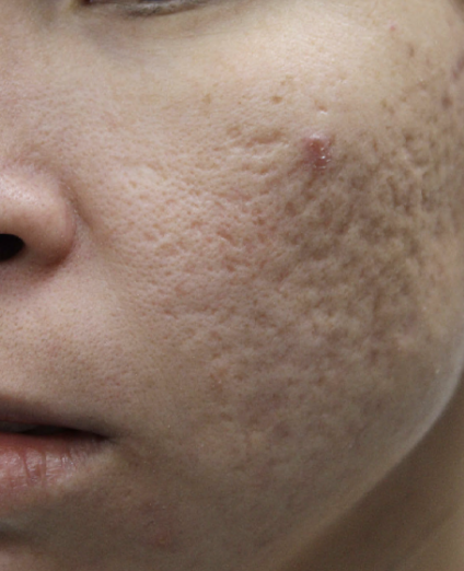 Before Acne Treatment