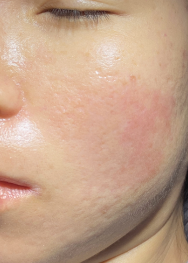 After Acne Treatment