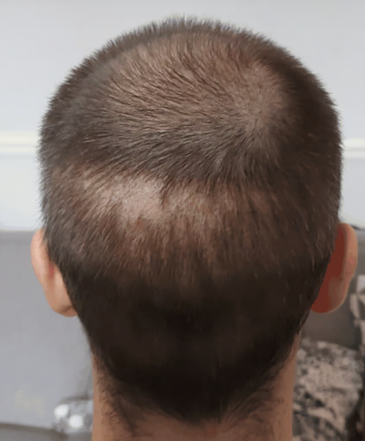 Before PRP Treatment