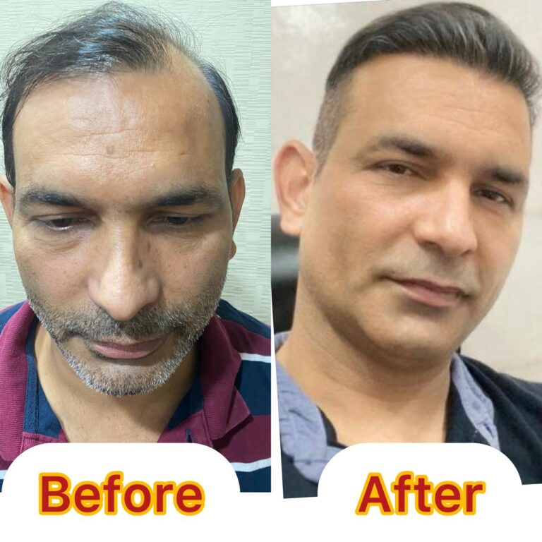 Hair Transplant in Lucknow – Complete Guide by DHT Clinics