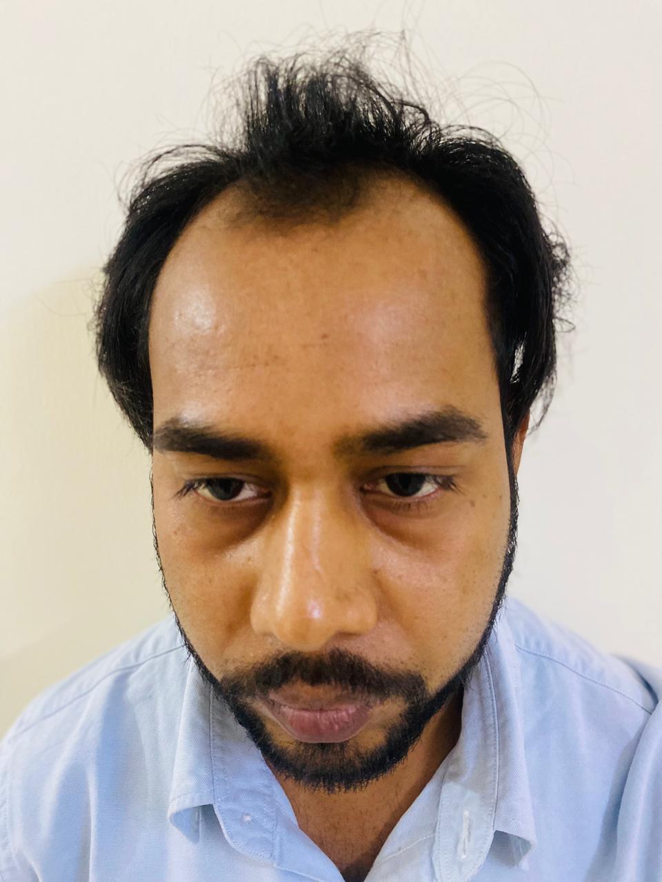 Before Hair Transplant