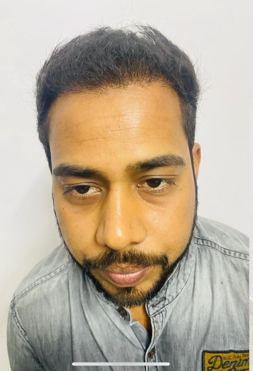 After Hair Transplant