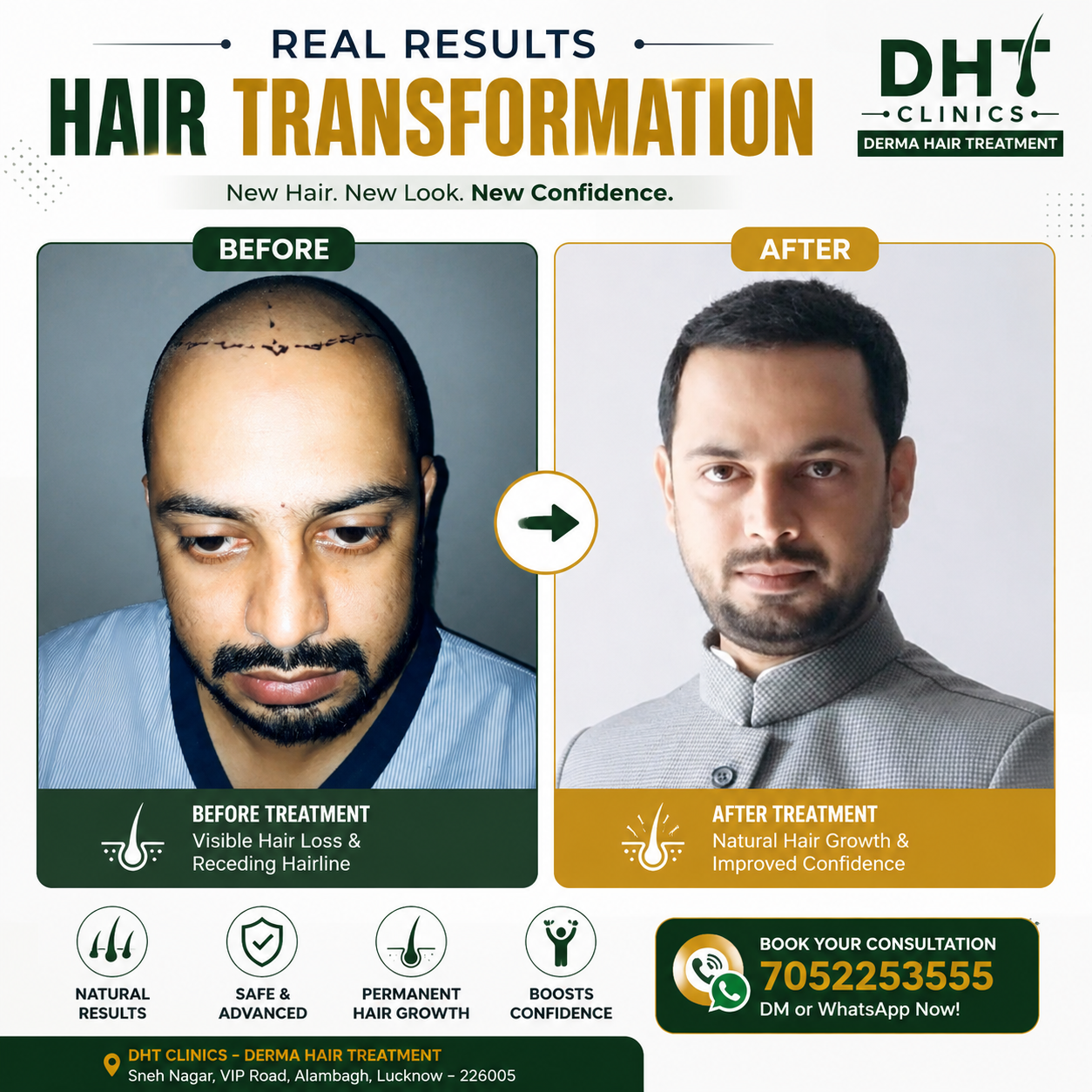 Hair Transplant Before and After Result