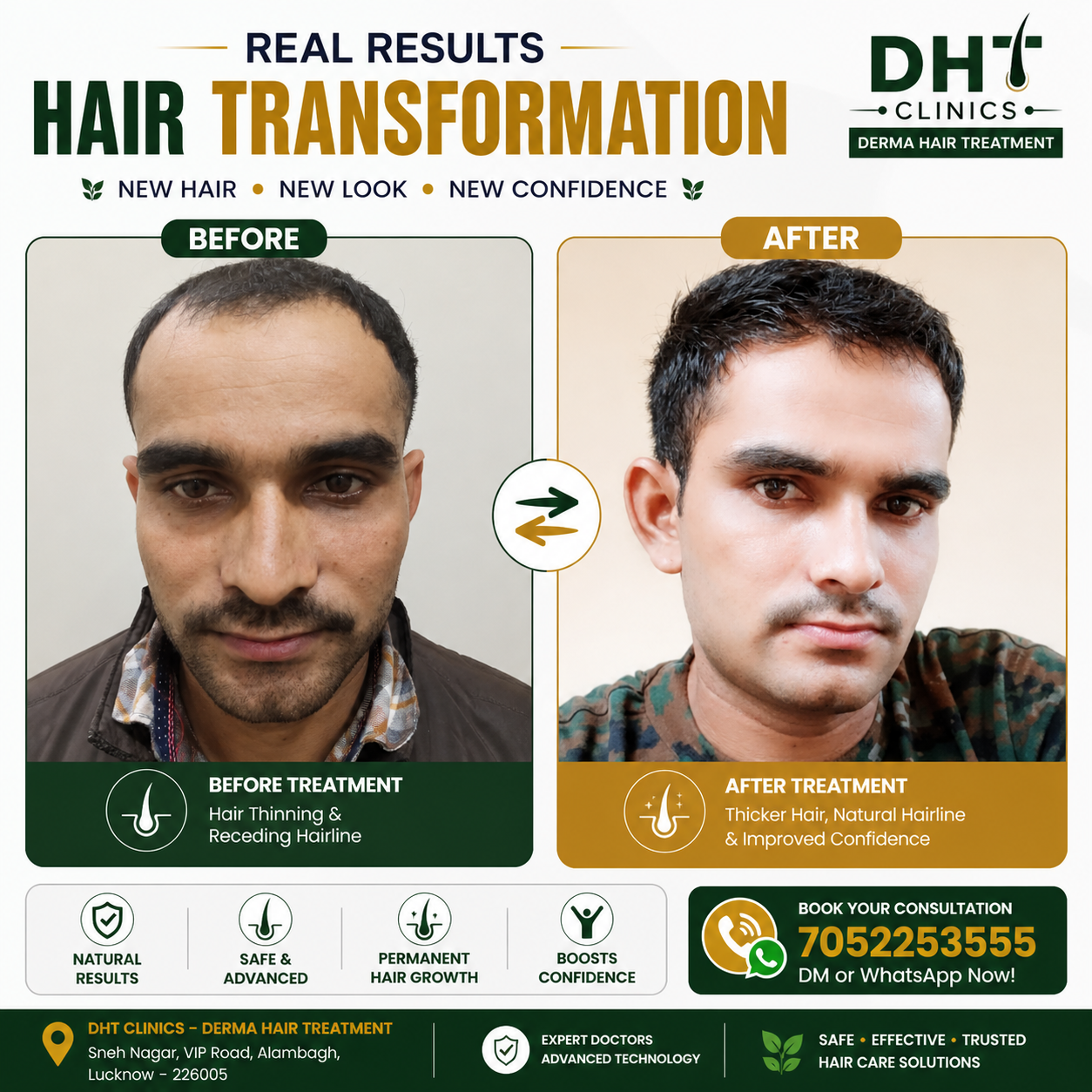 Hair Transplant Before and After Result