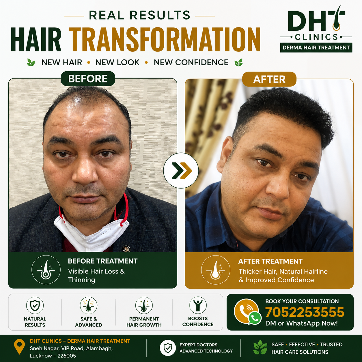 Hair Transplant Before and After Result