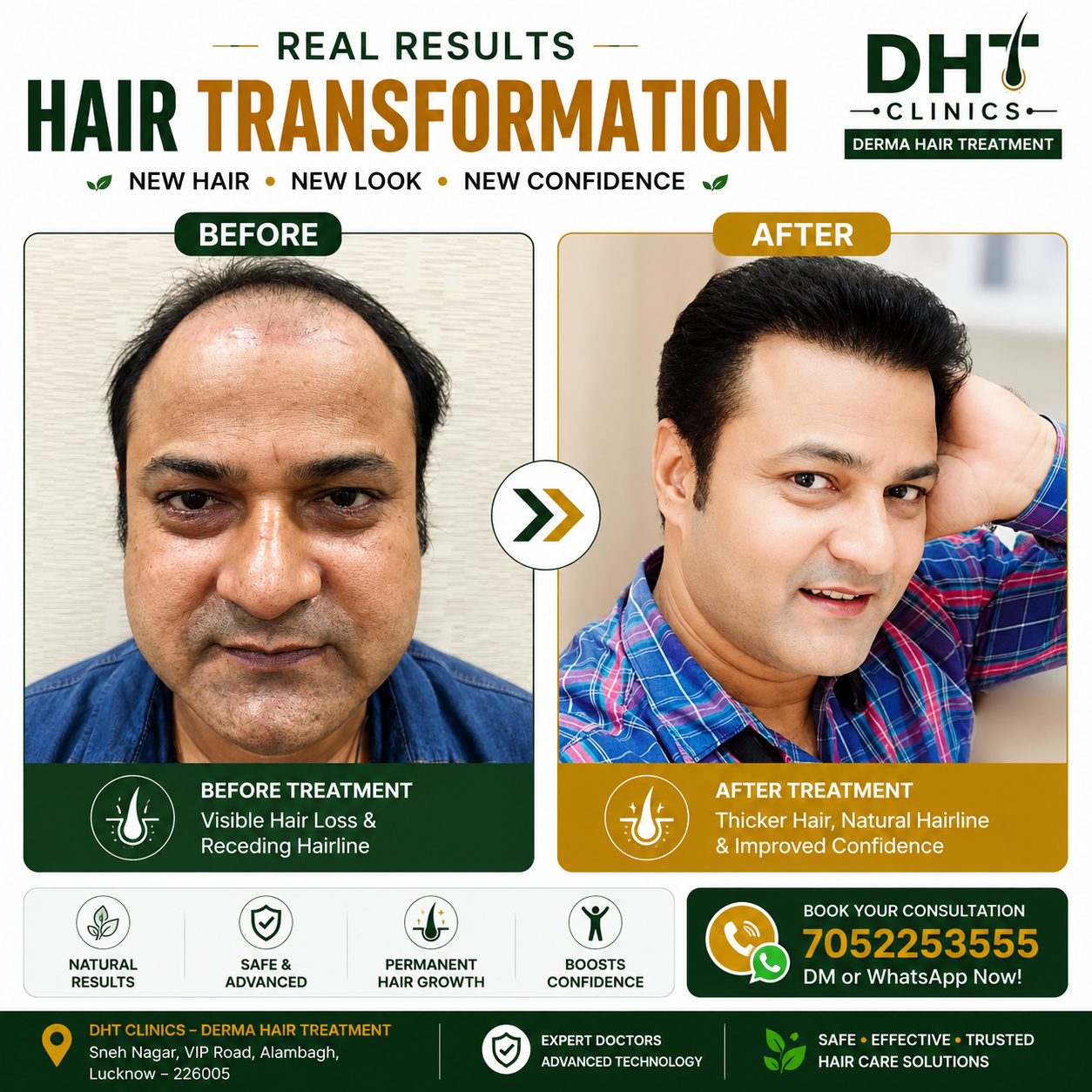 Hair Transplant Before and After Result