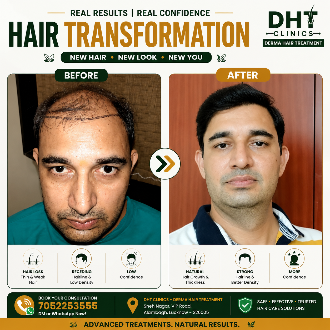 Hair Transplant Before and After Result