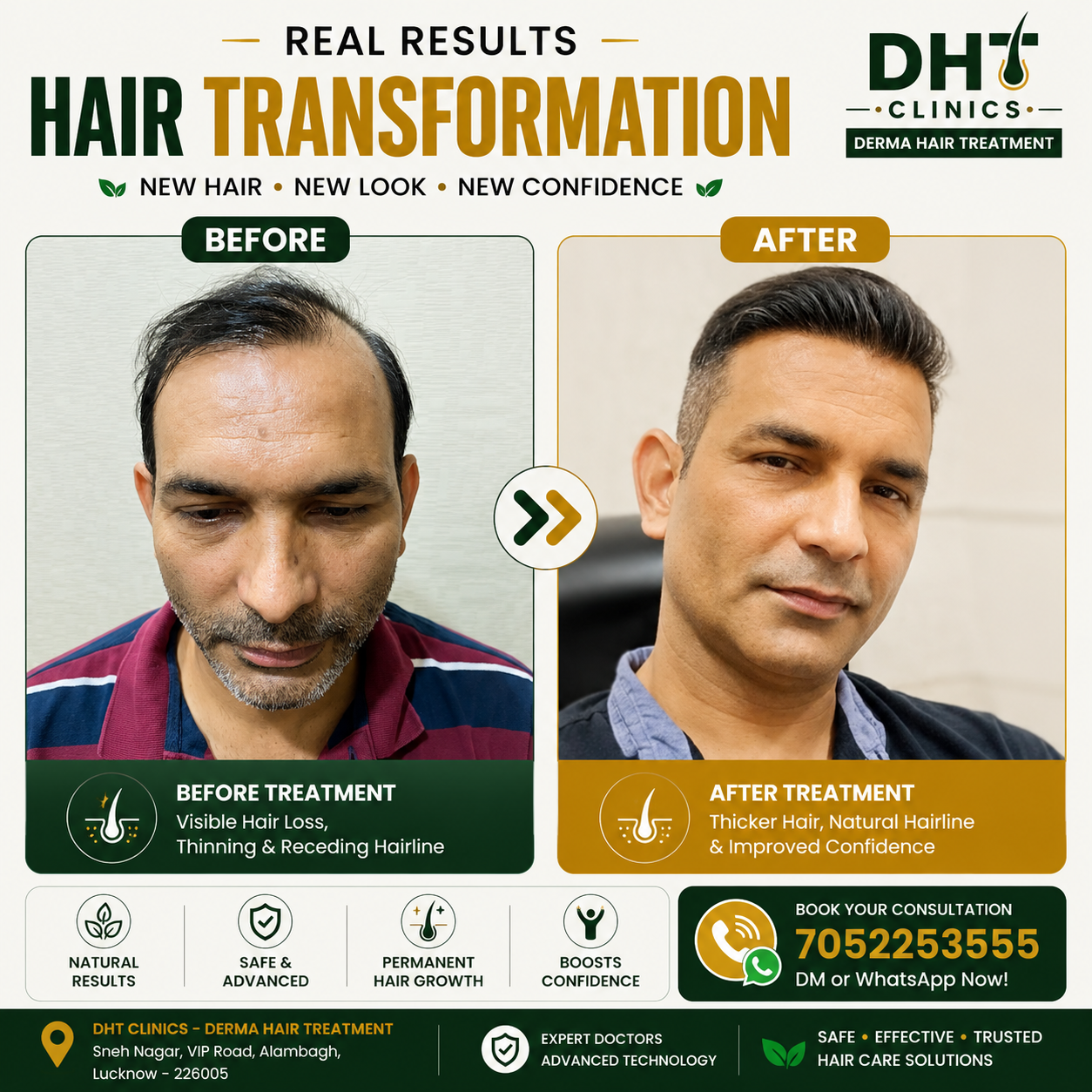 Hair Transplant Before and After Result