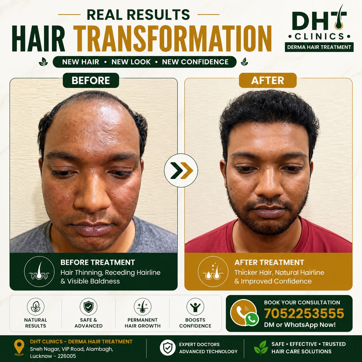Hair Transplant Before and After Result