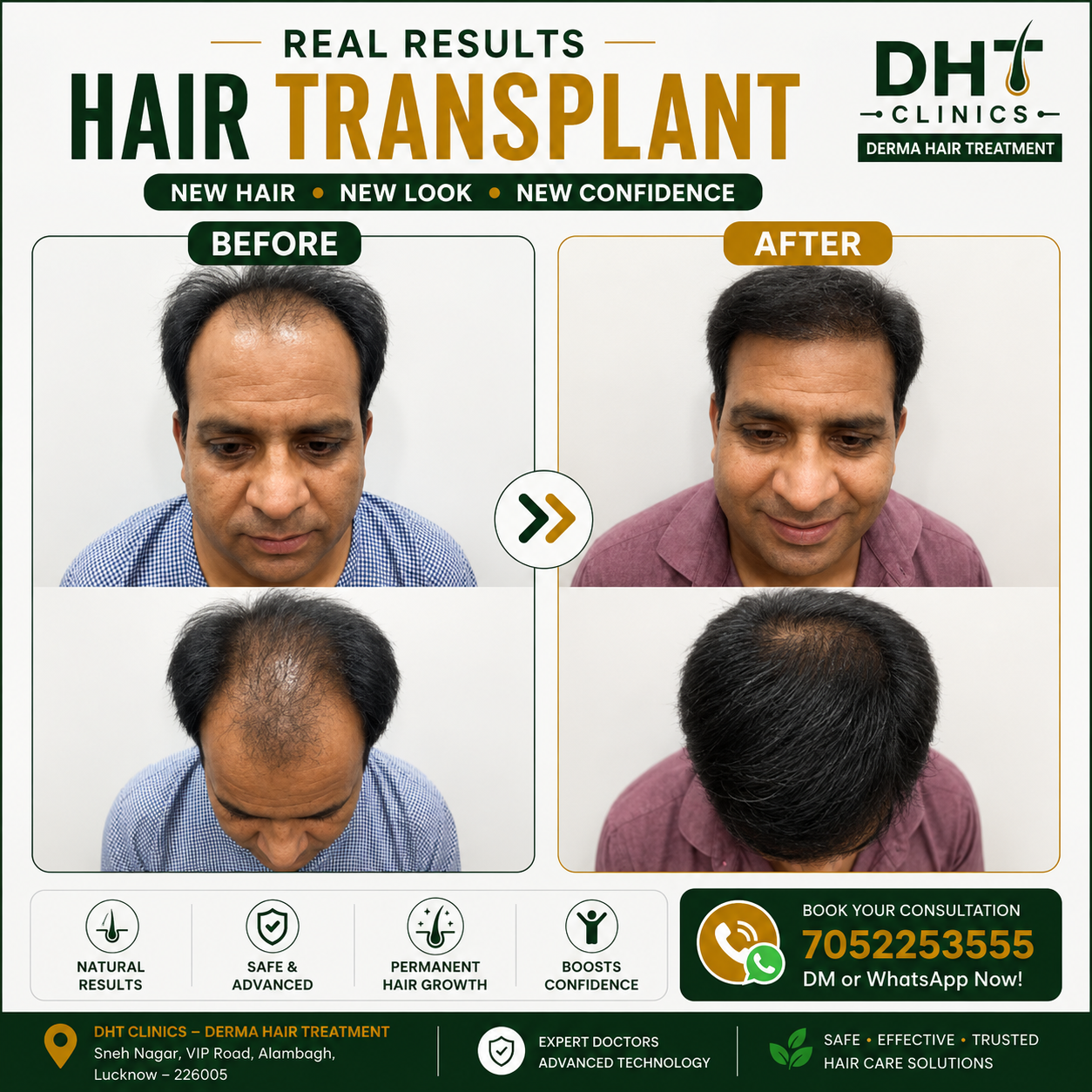 Hair Transplant Before and After Result