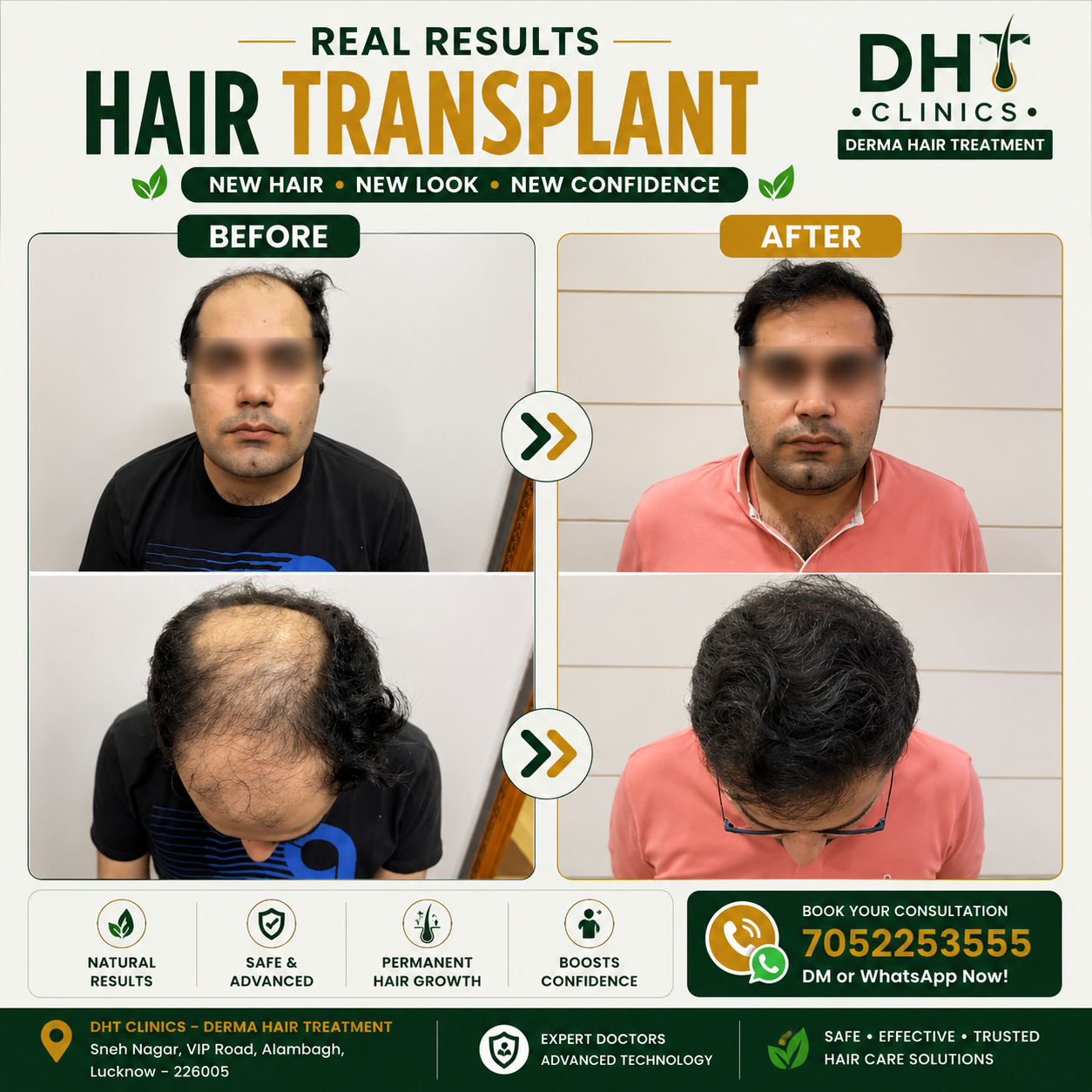 Hair Transplant Before and After Result